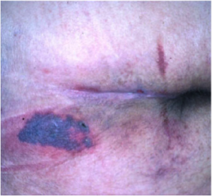 A phenomenon called “3:30 Syndrome” presented as a subdivision of the Kennedy Terminal Ulcer, which forms more quickly and appears as black spots.
