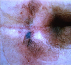 The classic “butterfly” or “horseshoe” shape of the Kennedy Terminal Ulcer. 