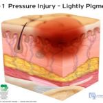 stage 1 pressure injury