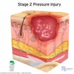 stage 2 pressure injury