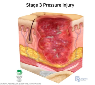 Action Pad : Pressure ulcer prevention : 【Official】ACTION JAPAN INC.