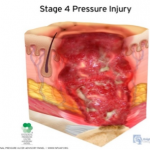 stage 4 pressure injury