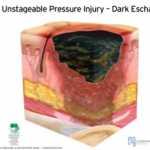 unstageable pressure injury - dark eschu