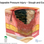 unstageable pressure injury - slough 
